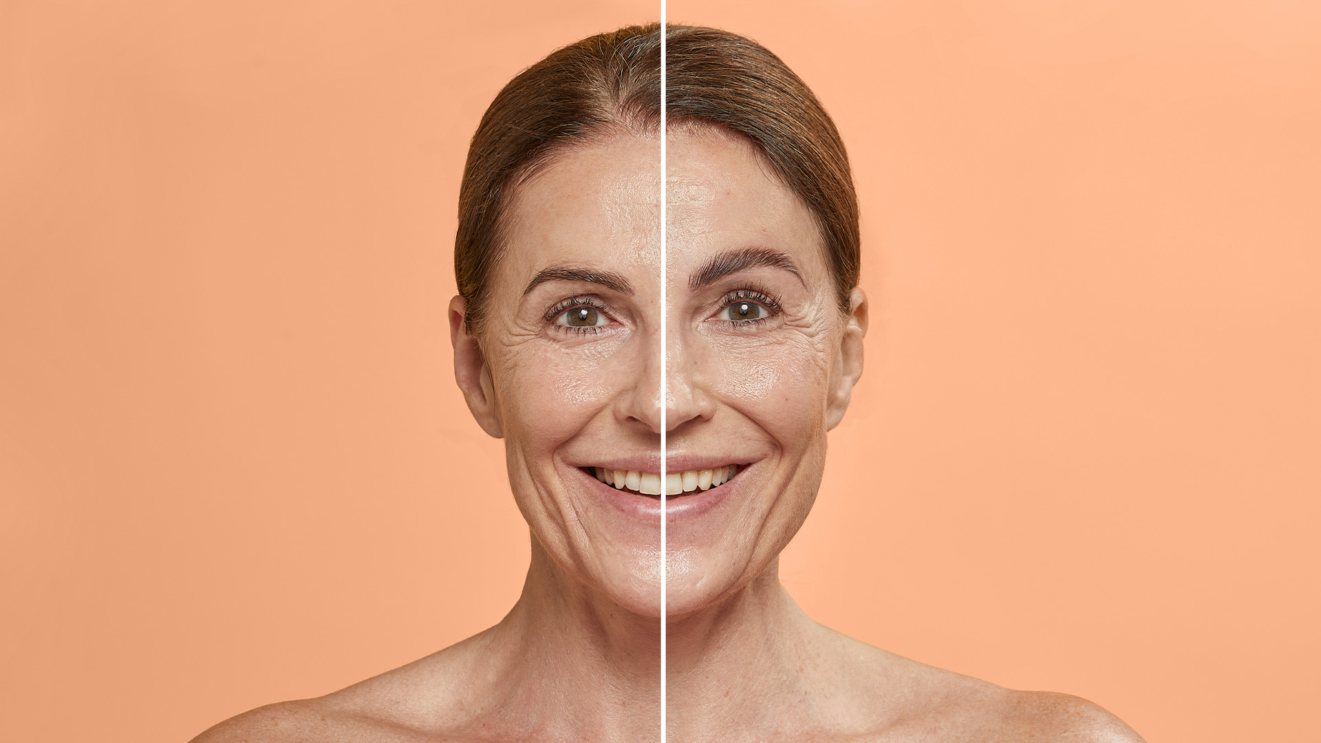 result-brow-lift voor en na resultaat wenkbrauw lift